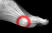 Sesamoid fracture