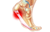 Plantar fasciitis