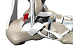 Peroneal tendon subluxation