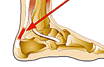 Achilles tendinosis