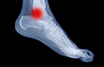 Osteochondral injury