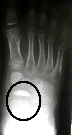 Abnormal Navicular (AP) “Coin on end”