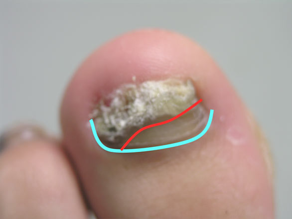 Fungal Toenails - View 4