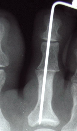 Capsulitis - 5