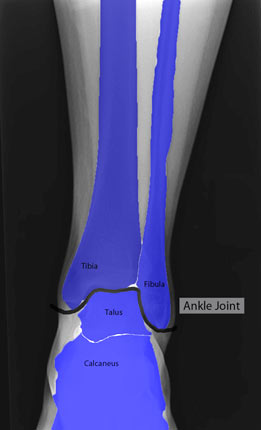 Ankle XRay