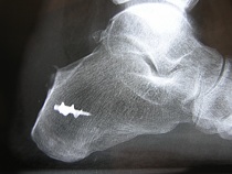 Retrocalcaneal Post-Op