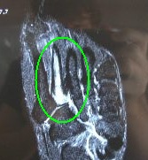 Metatarsal Stress Fracture