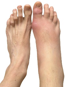Gouty arthritis present in Right foot